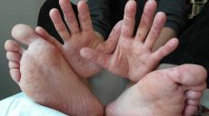 В Харькове областную детскую больницу закрыли на карантин из-за кори – вице-губернатор