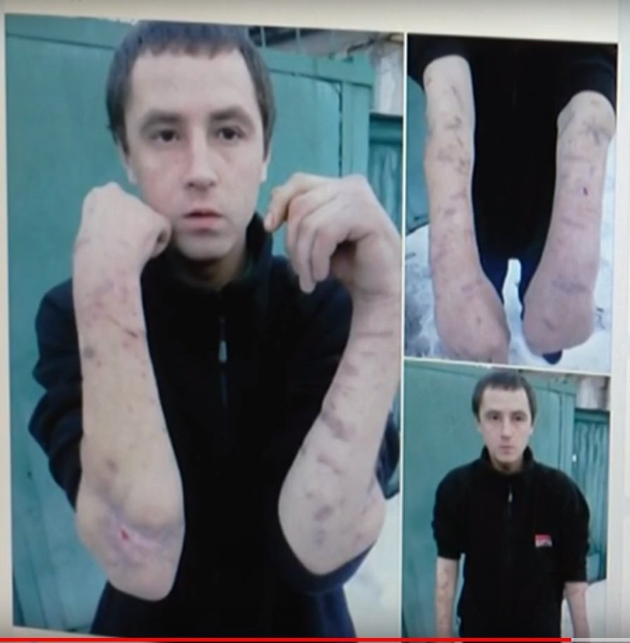 Господар собак, які ледь не загризли чоловіка, відмовляється платити за реабілітацію (відео)