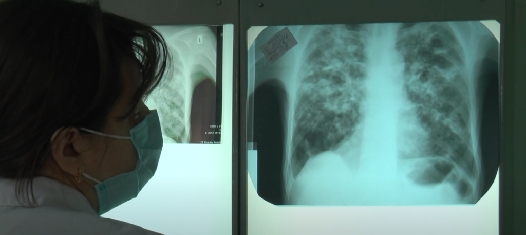 Як COVID вплинув на захворюваність на туберкульоз на Харківщині (відео)