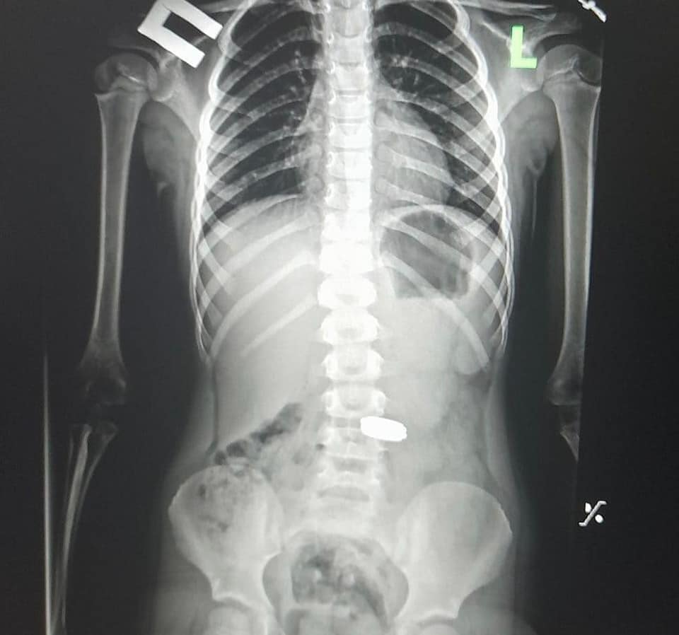 Монети в шлунку дитини на рентгені