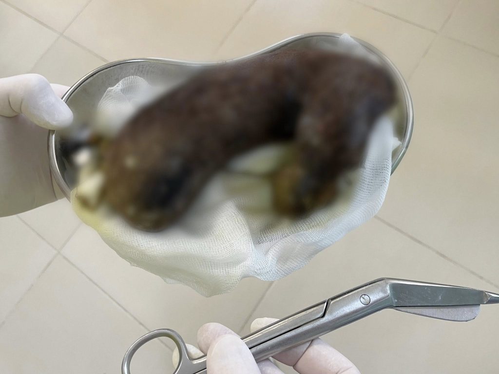 Клубок волос достали из желудка девочки