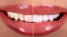 Порівняння матеріалів для естетичної реставрації: кераміка проти композиту